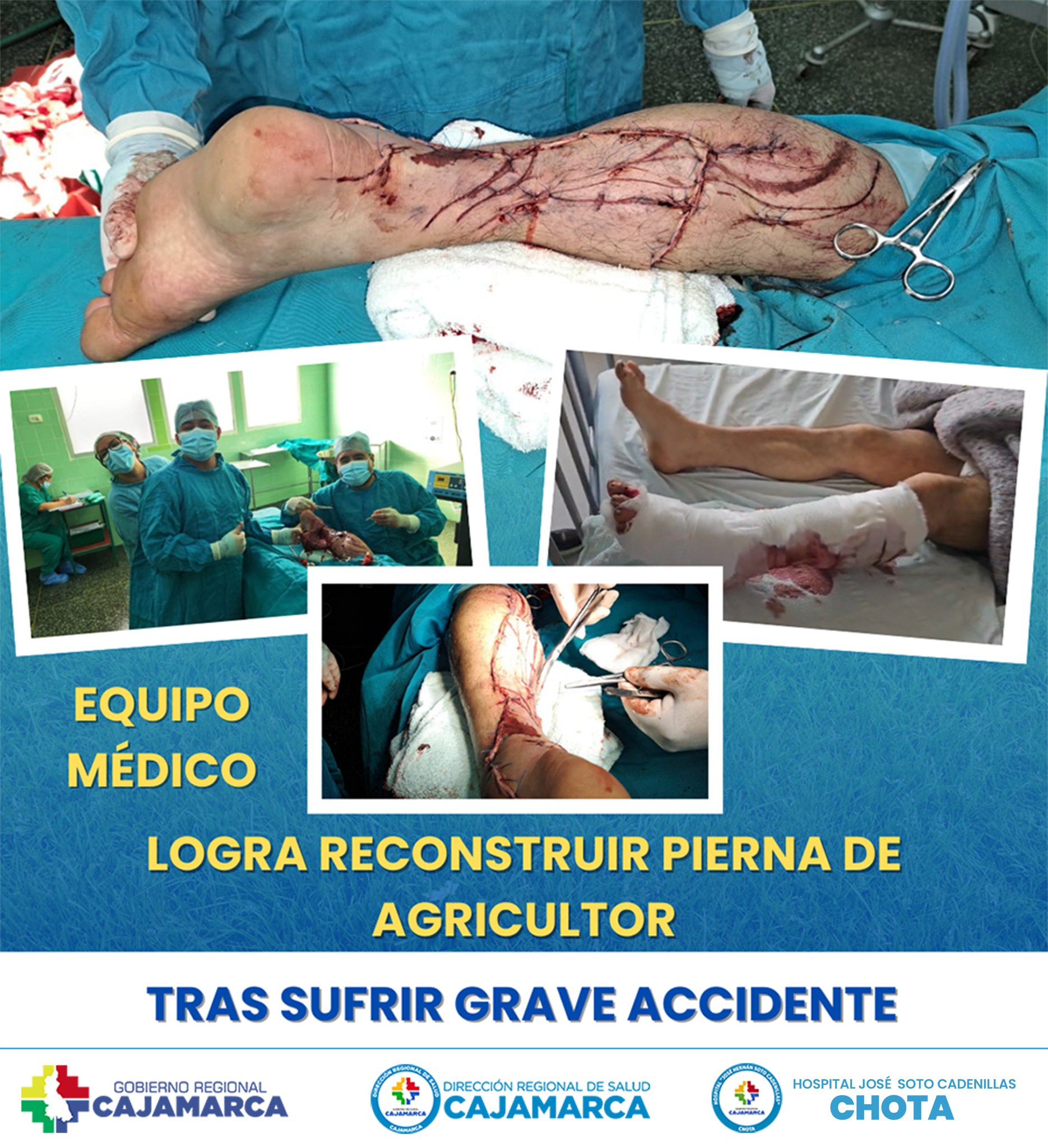 Médicos realizan exitosa reconstrucción de pierna