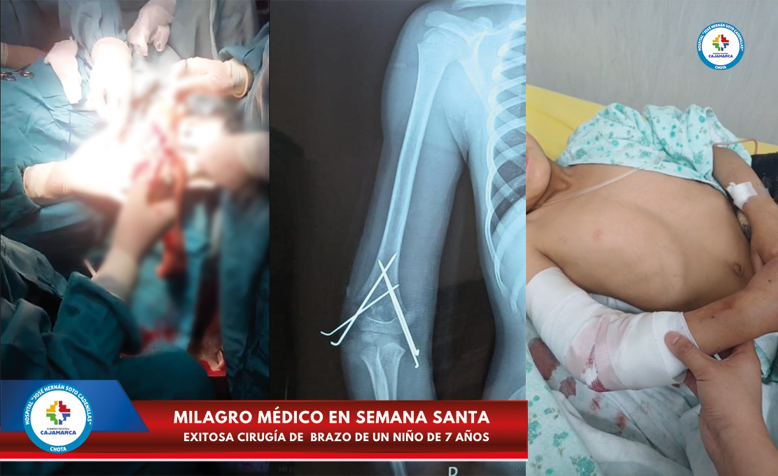 Exitosa cirugía de brazo de un niño