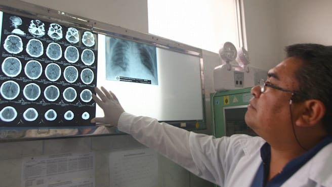 El accidente cerebrovascular o ictus isquémico es la segunda causa de muerte en el Perú