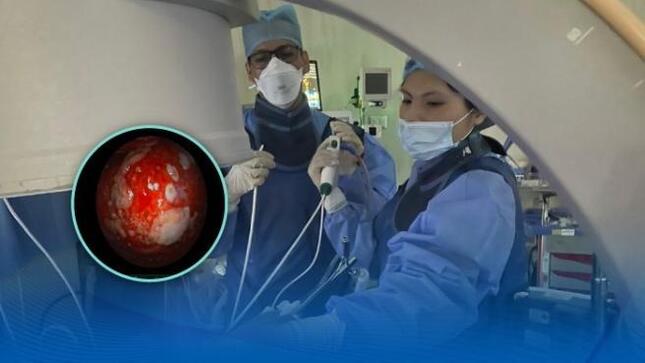 Hospital Dos de Mayo implementa técnicas innovadoras para el diagnóstico temprano de cáncer de pulmón