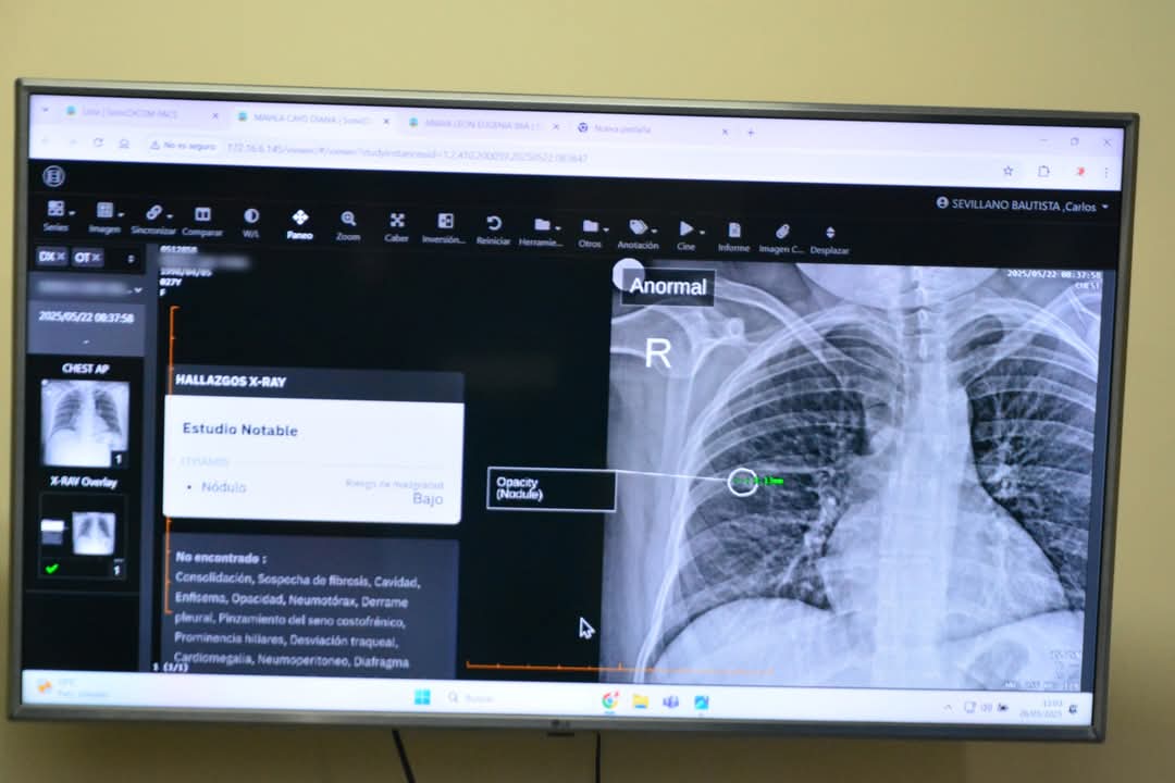 Minsa empieza a detectar neoplasias pulmonares en menos de un minuto gracias a la IA en el Hospital María Auxiliadora