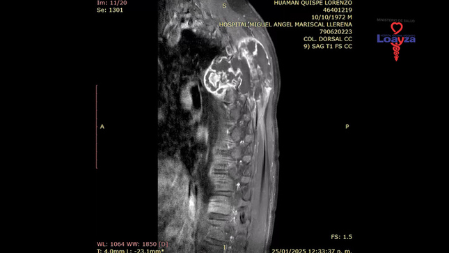 Un esfuerzo médico multidisciplinario salva la vida de paciente con tumor torácico de gran tamaño 
