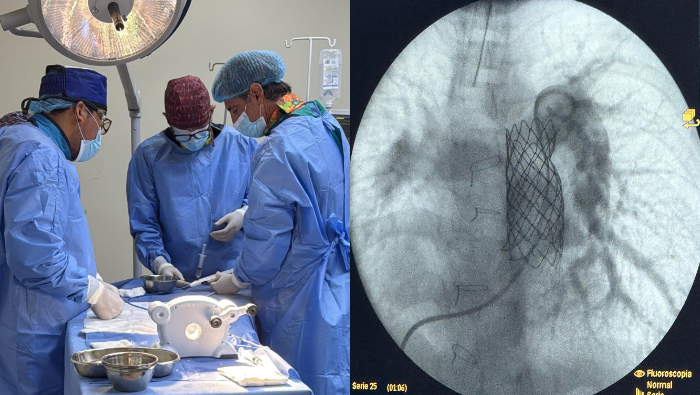 Cardiólogo argentino y equipo de médicos del INSN colocan implante de válvula pulmonar a pacientes