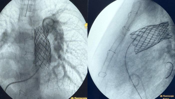 Cardiólogo argentino y equipo de médicos del INSN colocan implante de válvula pulmonar a pacientes