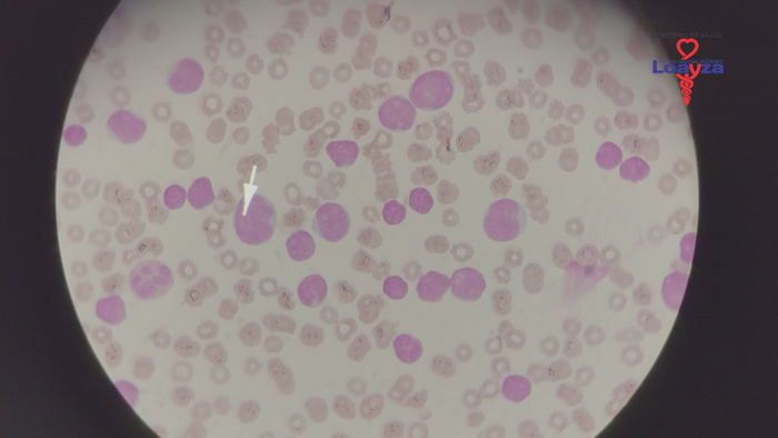 Bebidas energéticas y su vínculo con el cáncer de sangre: advertencia desde el Hospital Loayza