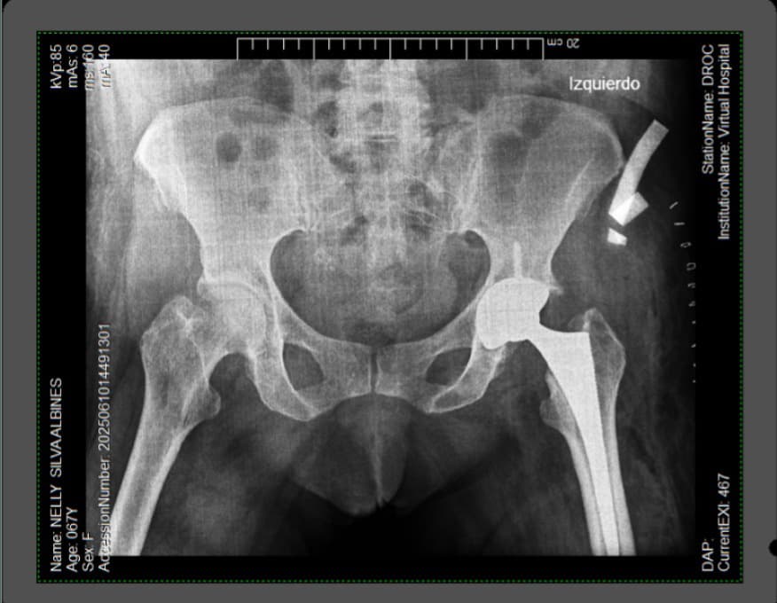 Hospital de Paita realiza con éxito primera artroplastia total de cadera a mujer de 46 años quien podrá volver a caminar